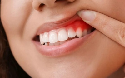 Dấu hiệu cảnh báo sớm viêm quanh răng và biện pháp cải thiện