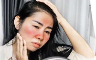 Da cháy nắng, cách điều trị và phòng ngừa thế nào?