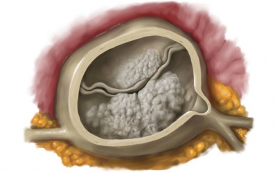 Vôi hóa van tim có nguy hiểm không và làm sao cải thiện?