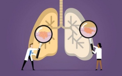 Các phương pháp điều trị ung thư phổi hiện nay