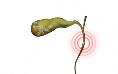 Sỏi ống mật chủ sau phẫu thuật có nguy hiểm không?