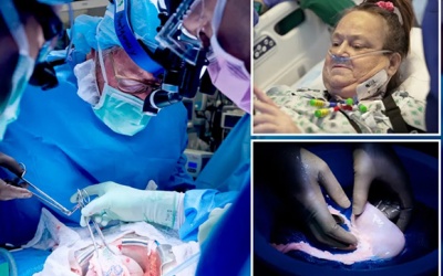 Người thứ 2 trên thế giới ghép thận lợn phải chạy thận trở lại