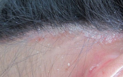 Vảy nến da đầu có phải gàu không?