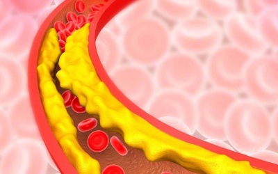 Dấu hiệu tắc nghẽn động mạch chớ chủ quan