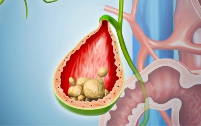 Người bệnh chia sẻ: Bí quyết giúp tan sỏi bùn lấp đầy túi mật