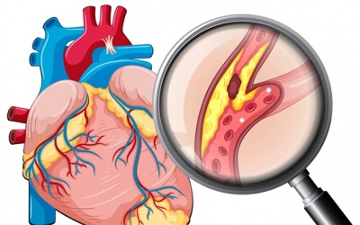 Vôi hóa mạch vành là bệnh gì, phải làm sao để cải thiện?