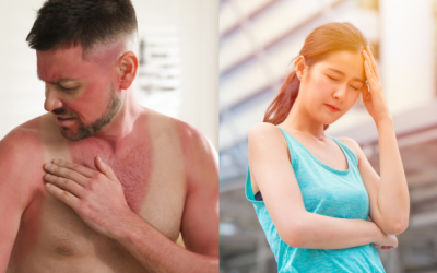 Làm thế nào để phân biệt cháy nắng và ngộ độc ánh nắng mặt trời?