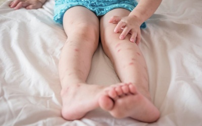 Mẹo xử lý sẹo thâm và vết muỗi đốt hiệu quả