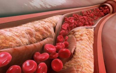 Nguyên tắc ăn uống giúp hạ mỡ máu xấu, tăng mỡ máu tốt