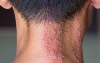 Cách giảm đau sau zona hiệu quả