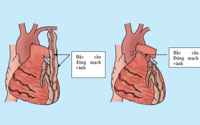 Một vài lầm tưởng thường gặp về bắc cầu động mạch vành