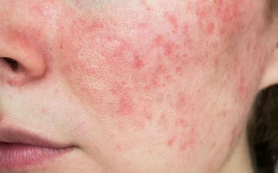 4 thực phẩm có thể khiến da bạn xấu đi