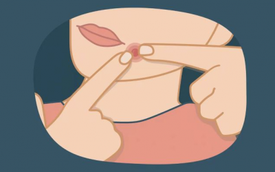 Tự ý nặn mụn: Thói quen gây nghiện khiến làn da 'khóc thét'!