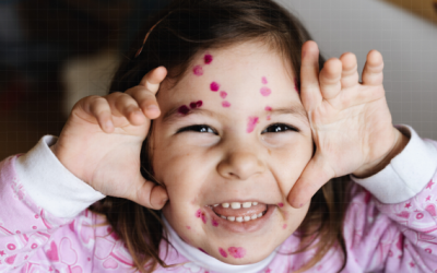 Cách phòng ngừa bệnh thủy đậu an toàn và hiệu quả