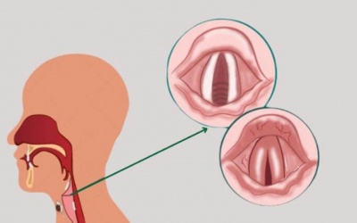Nguyên nhân gây viêm thanh quản mạn và cách đối phó hiệu quả
