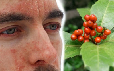 Vảy nến ở mũi và giải pháp từ thảo dược