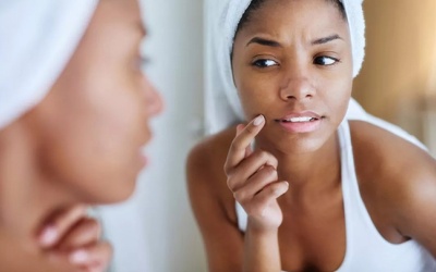 Bác sĩ da liễu chỉ cách ngăn ngừa mụn trong mùa Hè