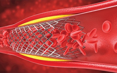 Bị bệnh mạch vành nhưng không đặt stent có được không? 