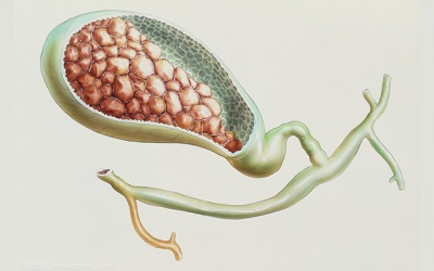 Chia sẻ: Bí quyết tan được sỏi mật 15mm mà không cần mổ