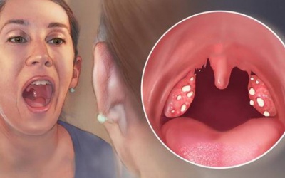 Viêm amidan hốc mủ có tự khỏi không?