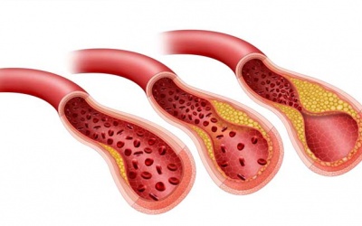 Thiểu năng mạch vành là gì và có điều trị khỏi được không?