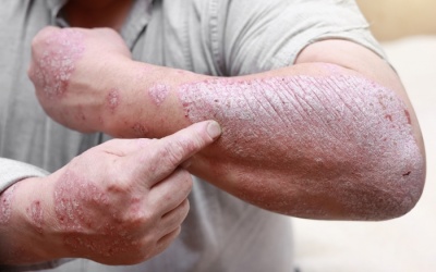 Vảy nến không điều trị sớm có thể gây nhiều biến chứng nguy hiểm