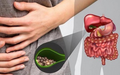 Làm sao ngăn sỏi túi mật 18mm gây triệu chứng?