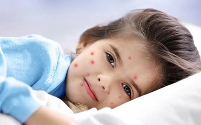 Những lưu ý giúp trẻ nhanh khỏi bệnh thủy đậu