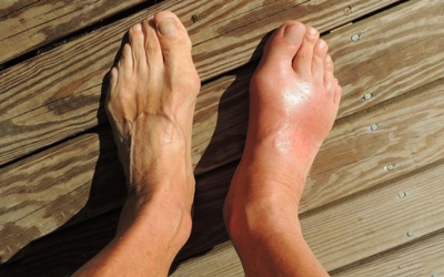 Gout cấp - Cách phát hiện và điều trị hiệu quả
