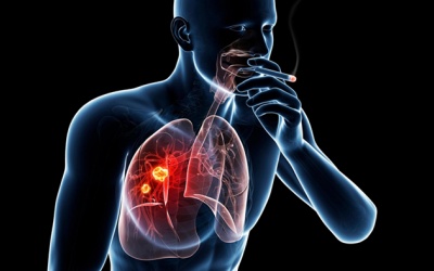 Yếu tố nguy cơ dẫn đến ung thư phổi biểu mô tuyến