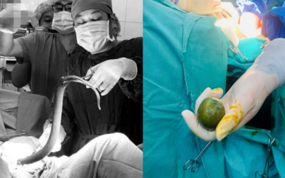 Thử cảm giác lạ, nam thanh niên phải phẫu thuật gắp lươn trong ổ bụng