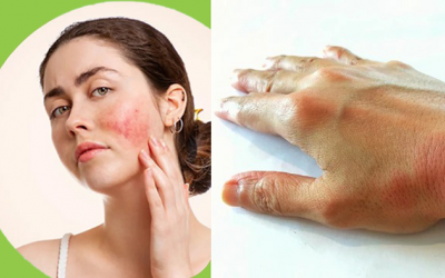 Người bị lupus ban đỏ gặp phải những rắc rối gì trên cơ thể?
