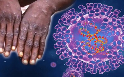 WHO ban bố tình trạng khẩn cấp toàn cầu lần thứ 2 vì bệnh đậu mùa khỉ