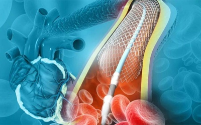 Tái hẹp động mạch vành sau đặt stent phải làm sao?