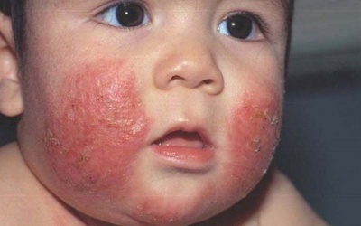 Trẻ béo phì có nguy cơ mắc bệnh chàm và vảy nến cao hơn