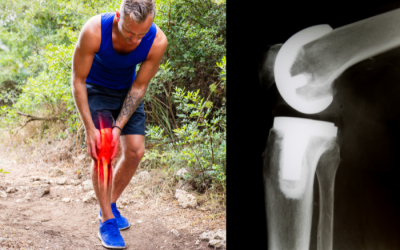 Vì sao bệnh nhân phẫu thuật thay khớp ngày càng trẻ hóa tại Mỹ?