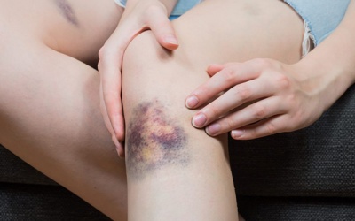 Nguyên nhân nào khiến cơ thể bạn dễ bầm tím?