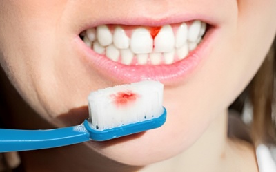 Điểm danh nguyên nhân gây chảy máu chân răng thường gặp
