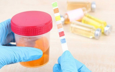 Phát hiện bệnh qua màu nước tiểu