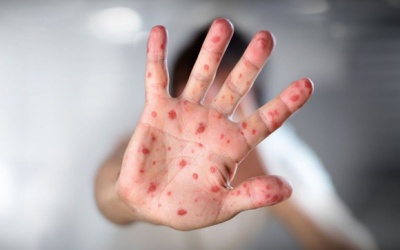 Vì sao TP.HCM phải công bố dịch sởi quy mô toàn thành phố?