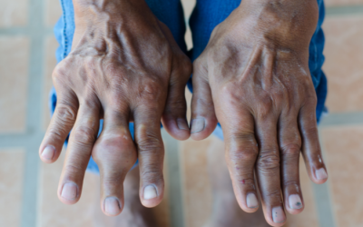 Nguyên nhân gây hạt tophi ở người mắc bệnh gout