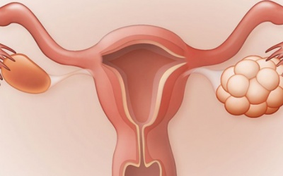 U nang nước buồng trứng là gì?