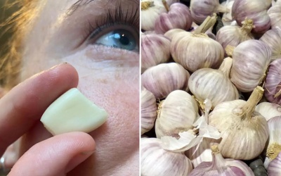 Thận trọng với trào lưu dùng tỏi trị mụn trên TikTok