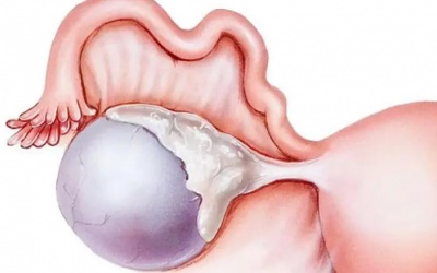 Dấu hiệu nhận biết u nang nhầy buồng trứng