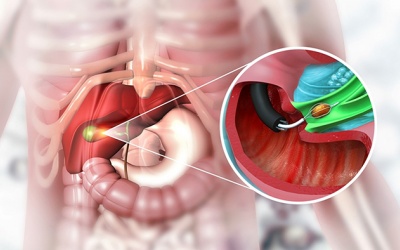 Xử trí thế nào khi bị viêm túi mật?