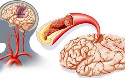 Thiếu máu não cục bộ: Dấu hiệu và cách cải thiện 