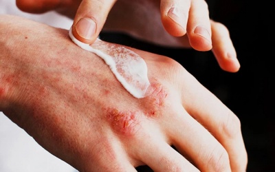 Biện pháp chăm sóc da tự nhiên cho người mắc bệnh chàm eczema