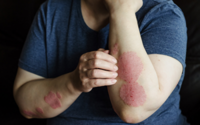 Vảy nến thể mảng có biểu hiện như thế nào?