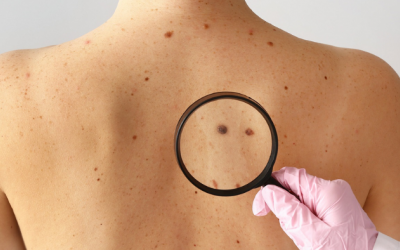 Những yếu tố làm tăng nguy cơ ung thư da, dấu hiệu nhận biết? 