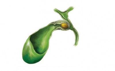 Sỏi ống mật chủ, sỏi đường mật: Không phẫu thuật được phải làm sao?